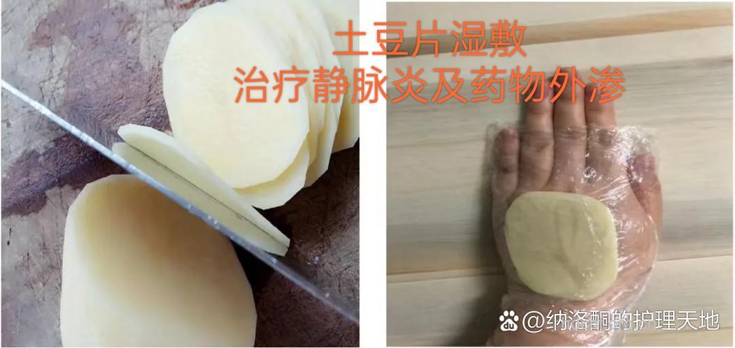 用敷土豆泥来治疗湿疹