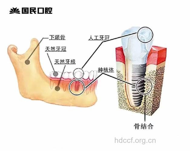 种植牙能否与骨能长在一起？