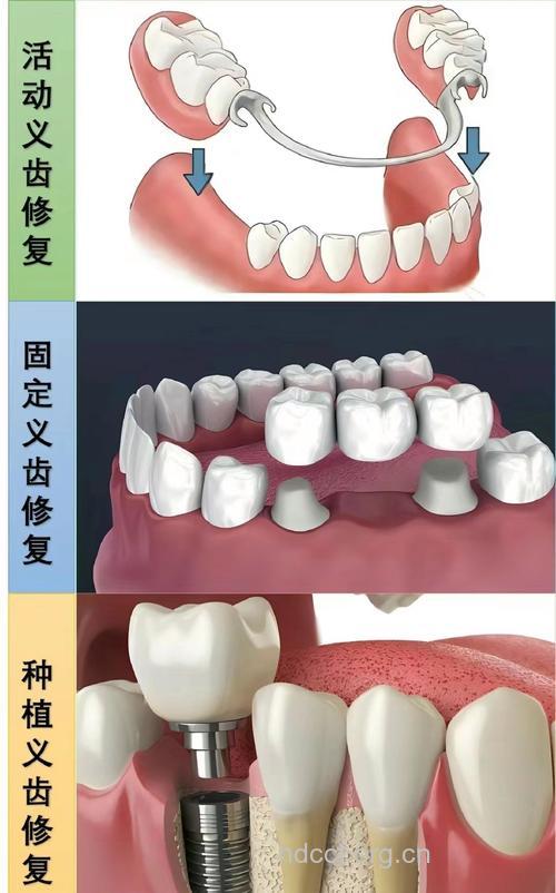 种植义齿的上部修复该如何设计?