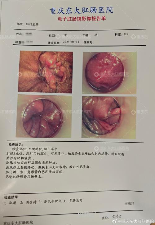 肛内肿物的病例检查
