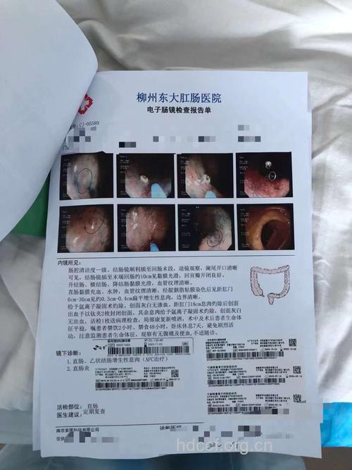 直肠息肉病例