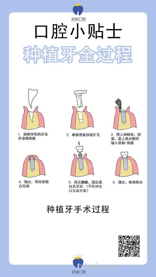 种植牙需做两次手术