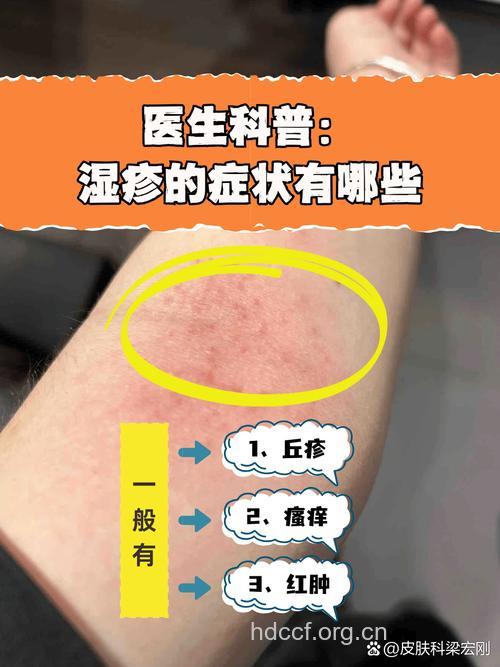 精神因素能导致湿疹的发生