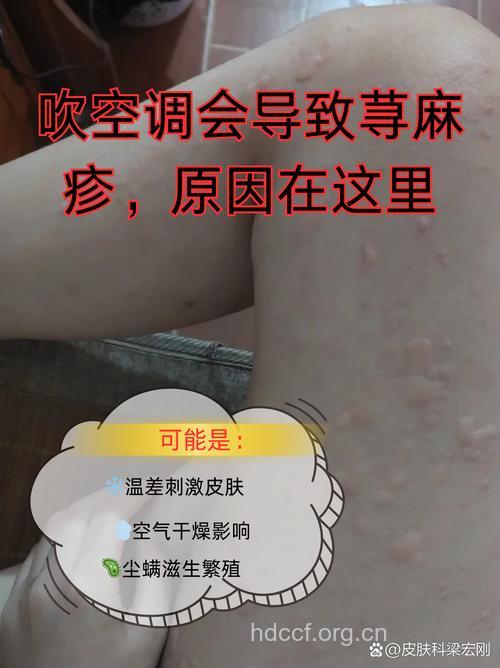 空调病来袭 湿疹易复发