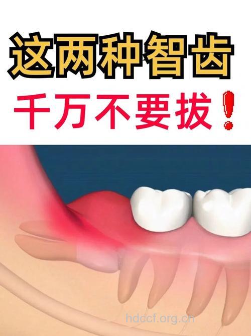 好的智齿不一定要拔除