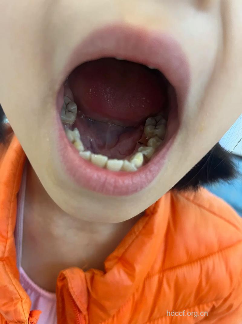 孩子有虫牙要拔牙吗