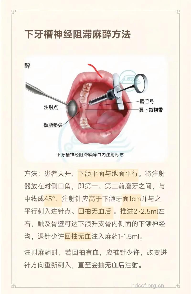 孕妇可以拔牙麻醉吗