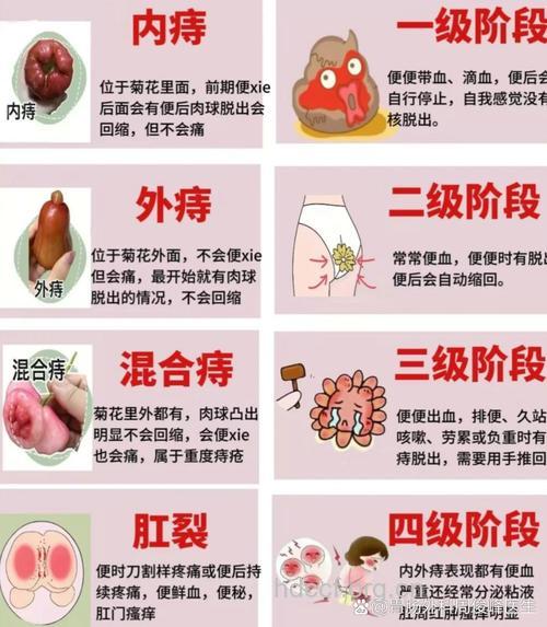 肛门息肉有哪些表现症状