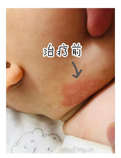 小孩子患湿疹能痊愈吗