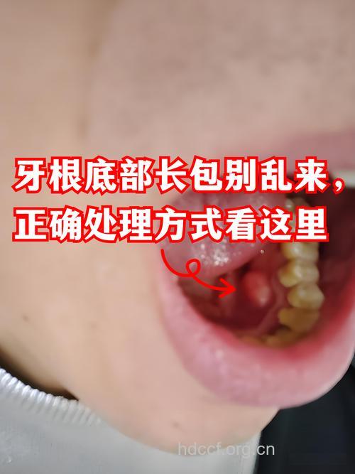 引发脑脓肿的“烂牙根”