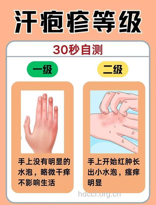 夏季按摩三穴位可防汗疱疹