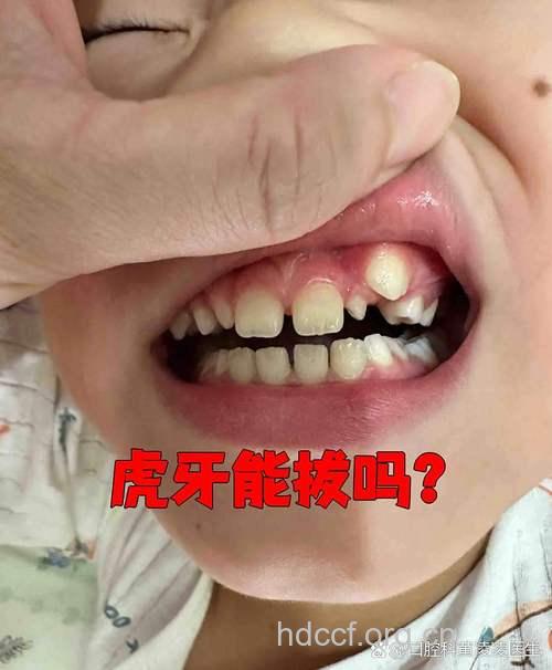 “虎牙”能不能拔