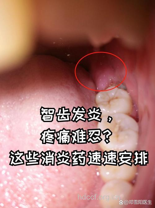 智齿发炎拔不拔？