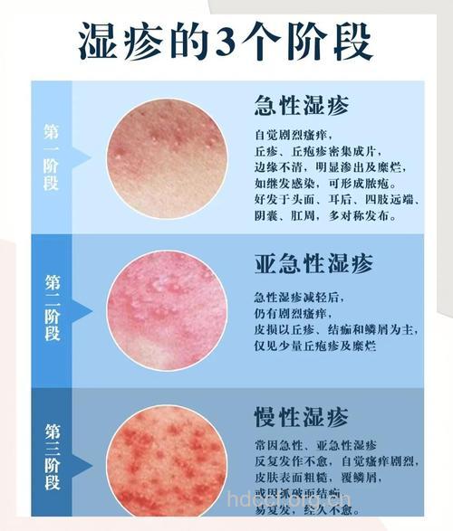 电磁辐射能否引起湿疹疾病