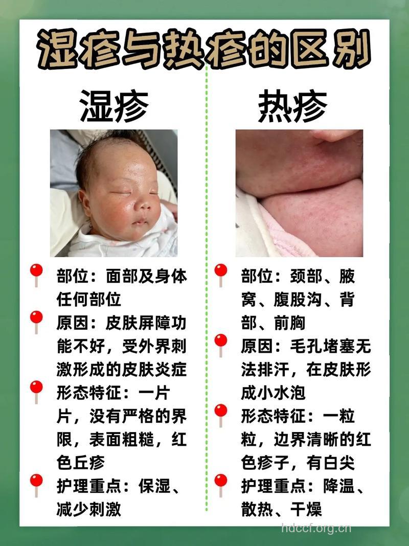 婴儿的湿疹与痱子区别在哪