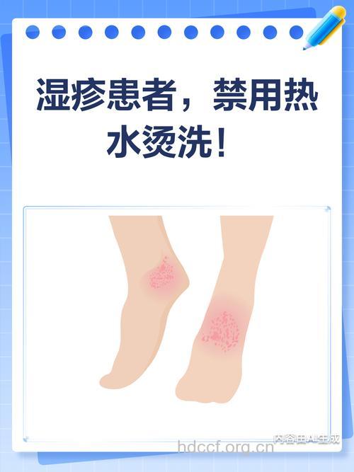 切记得了湿疹千万别用热水洗