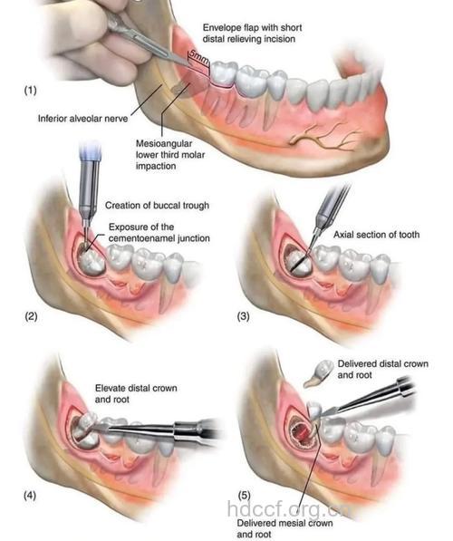 牙拔除术怎么来操作