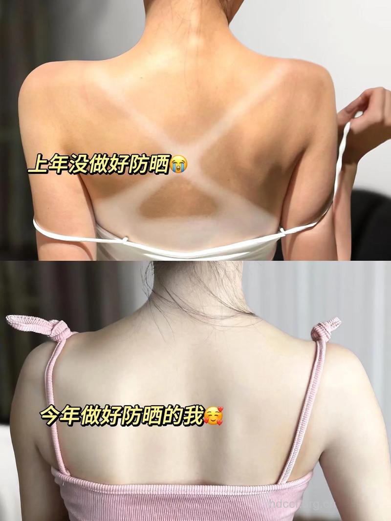 女性哪些部位最怕晒