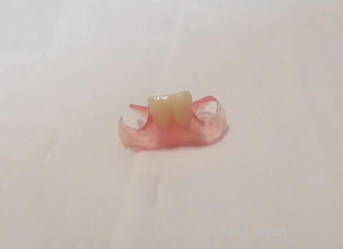 拔牙后要镶上假牙