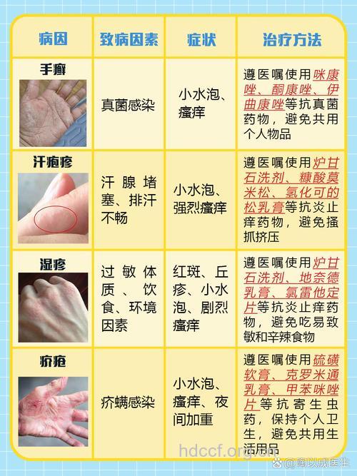 手上长小水泡的原因与治疗