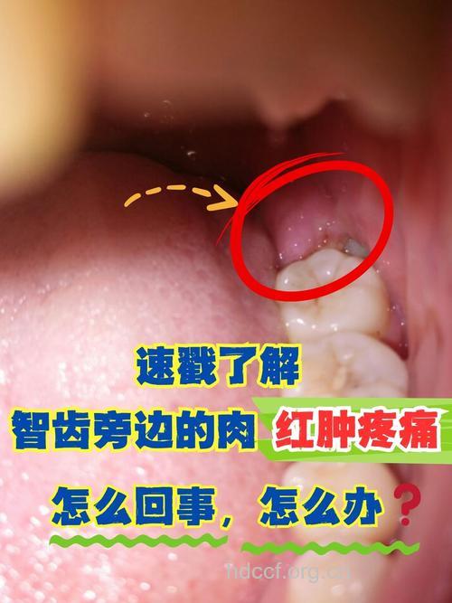 智齿发炎了还拔吗？