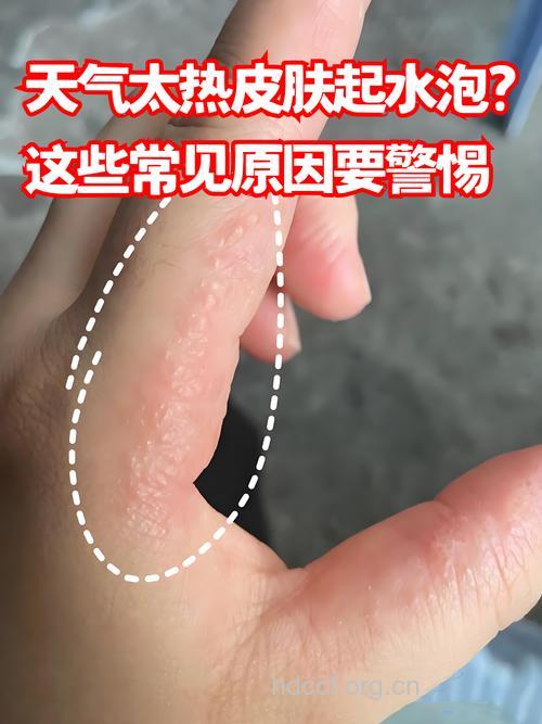 夏季雨水增多易诱发湿疹