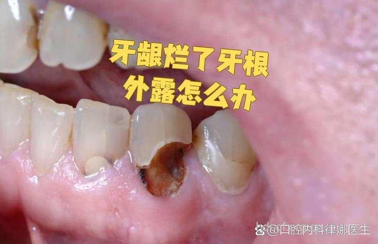 烂牙根祸害不浅