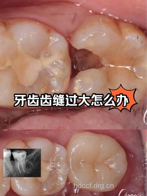 除掉烂牙根牙齿更健康