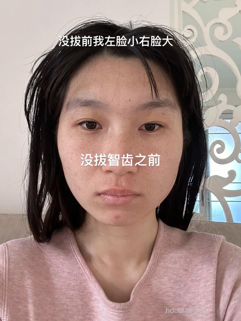 拔牙拔成“大小脸”?