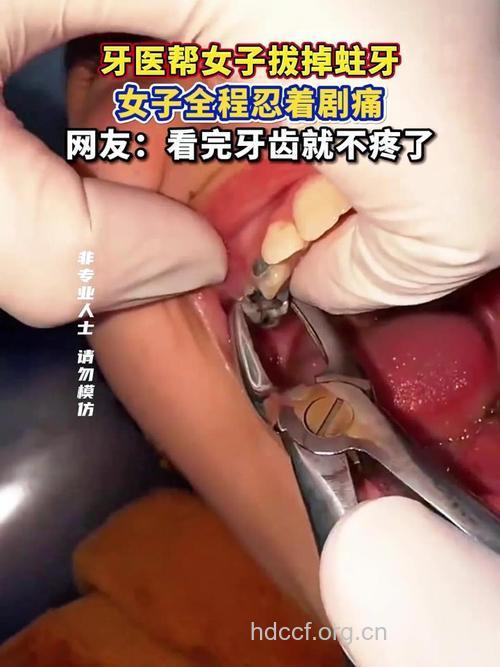 女性拔牙 不可以随便拔