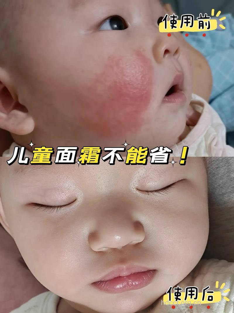 小儿脸部湿疹的表现症状