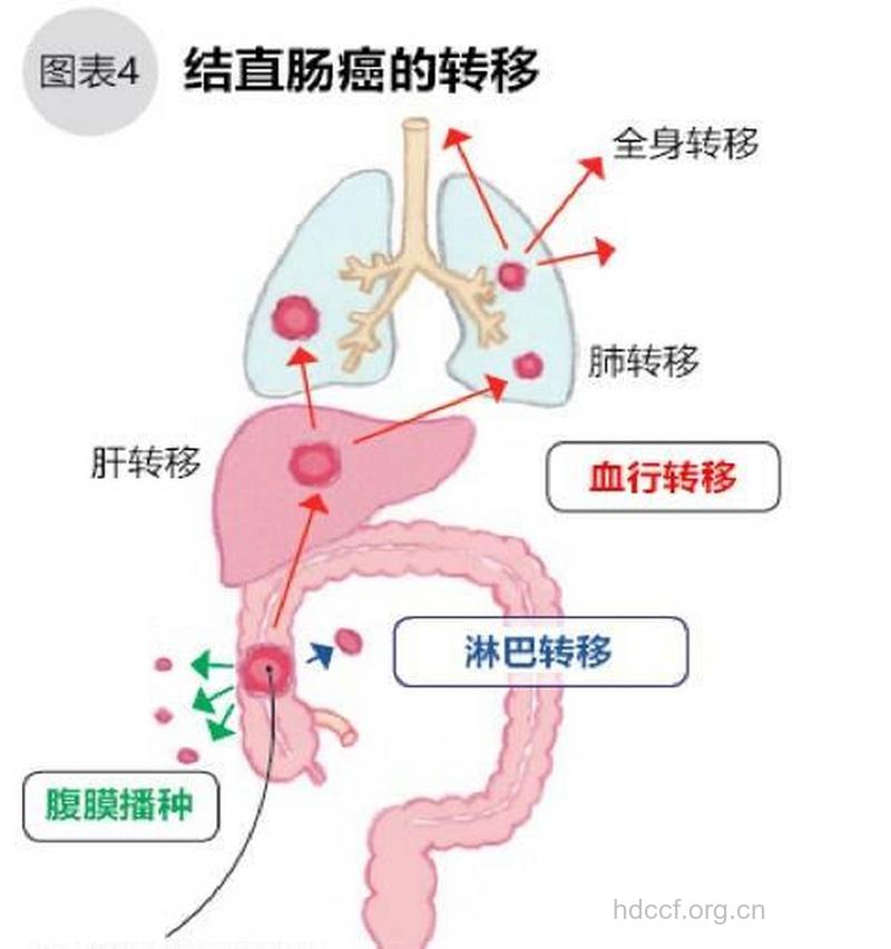 结肠癌有哪些转移途径?