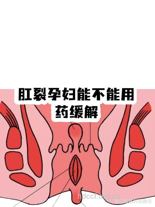 女性怀孕期间也易肛裂