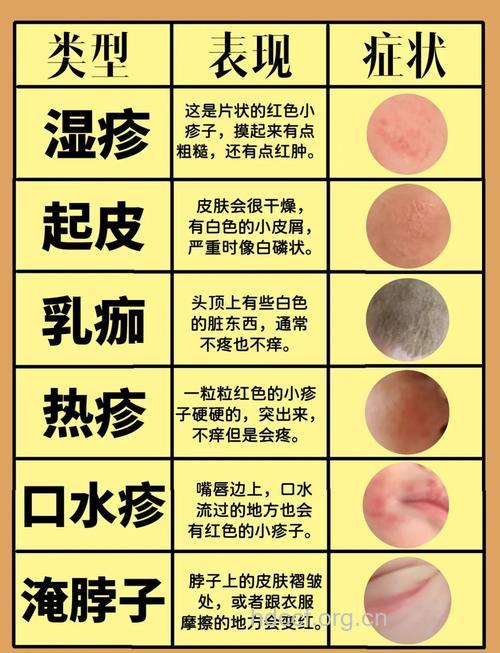 全面解析婴儿湿疹
