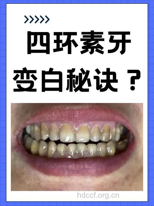 治疗四环素牙的4种牙齿美白方法