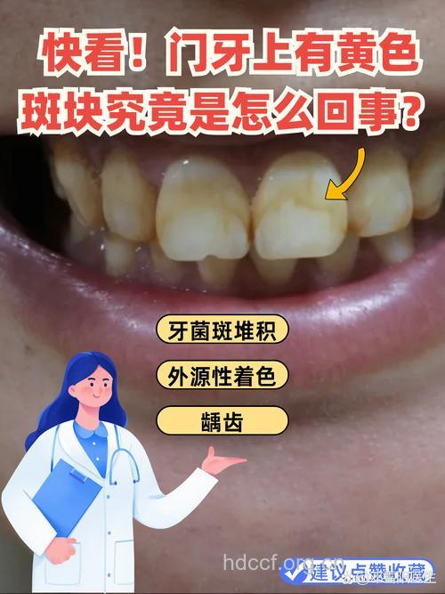 牙齿黄可能是黄斑牙