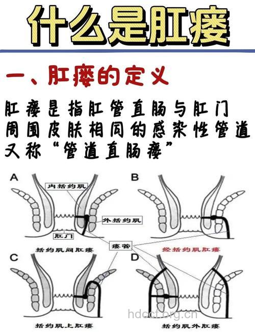 肛瘘发病的四大病理表现