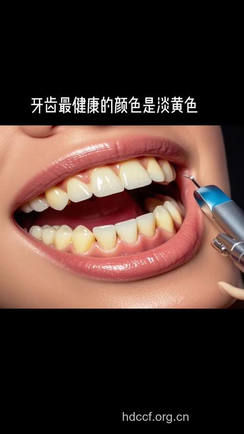 淡黄色牙齿才是最健康的