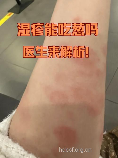 手机很有可能引发皮炎湿疹