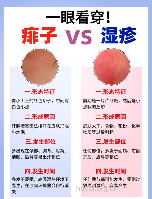 宝宝的湿疹和痱子有什么区别呢