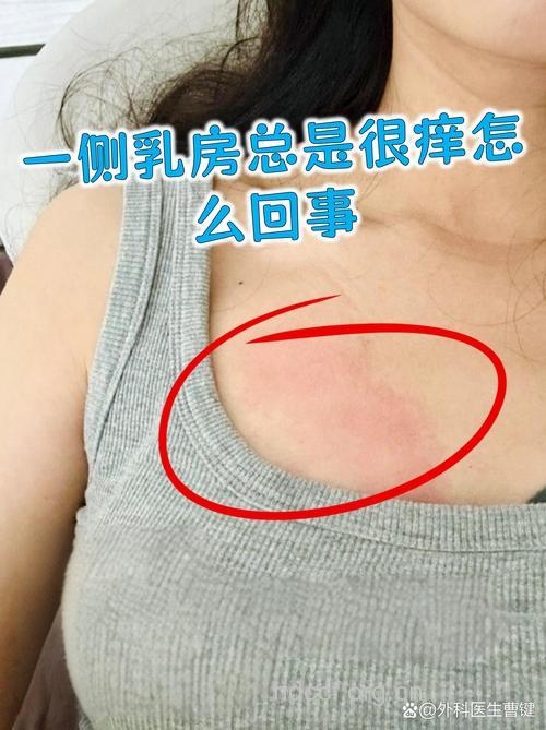 关注最常见的慢性乳房湿疹