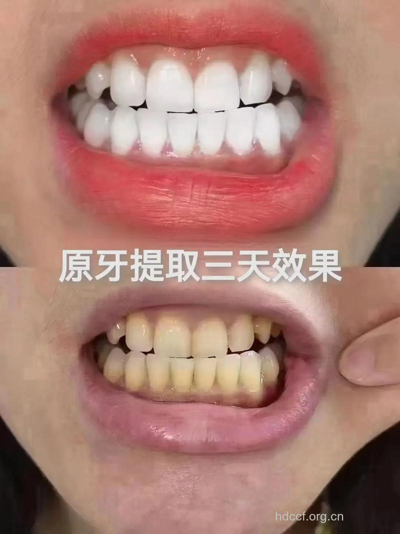 牙齿黑选什么牙齿美白方法好