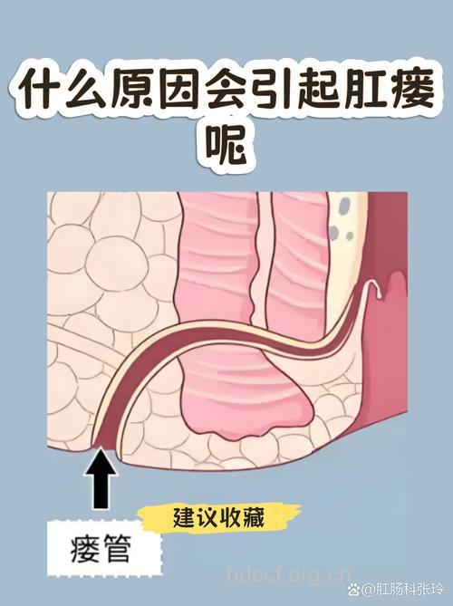 为什么新生儿会发生肛瘘呢