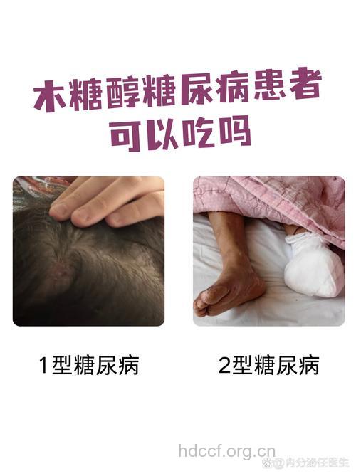 木糖醇可以治糖尿病吗