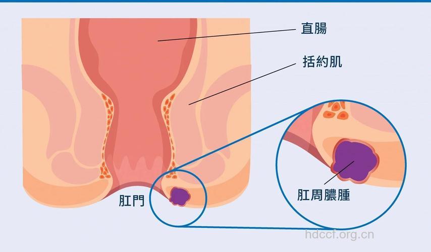 如何确定肛痿的内口位置