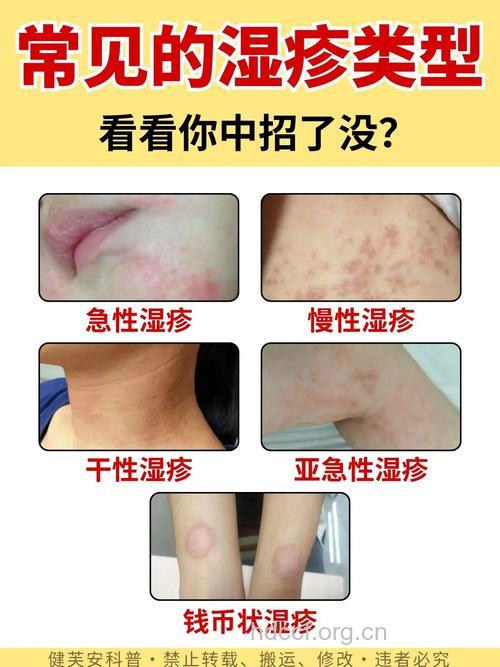 皮炎湿疹有哪些症状
