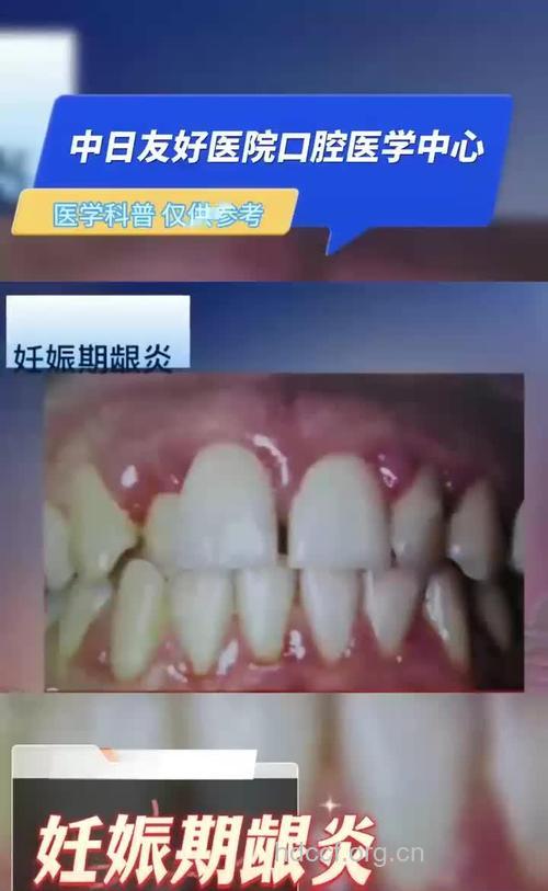 孕妇牙出血或是妊娠期牙龈炎