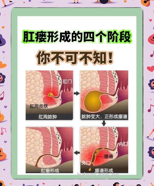 肛门瘘管的发展过程