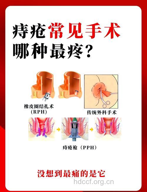 常见的痔疮易忽视 引起贫血必须手术