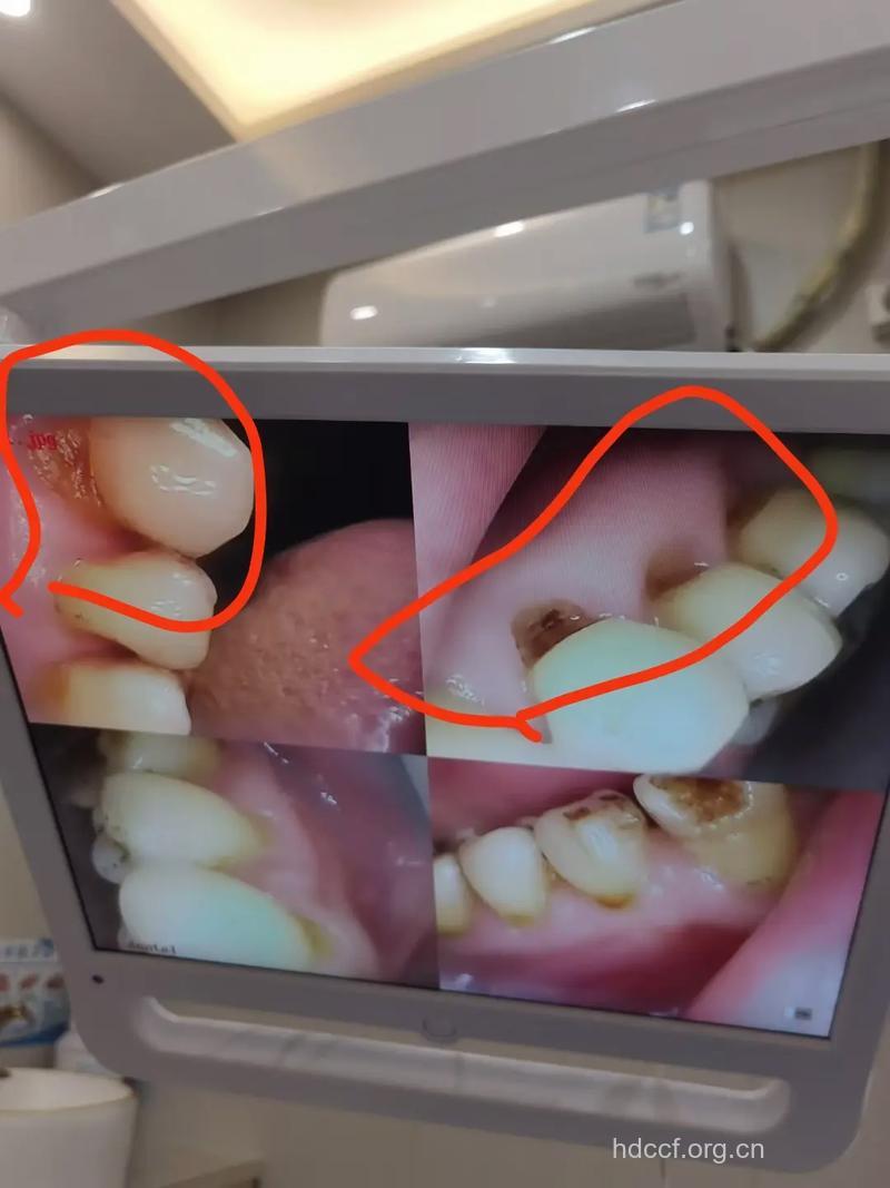 吃完水果后刷牙 反而对牙不好
